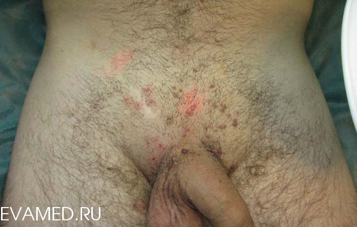 Остроконечные кондиломы