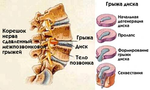 Межпозвонковые (межпозвоночные) грыжи
